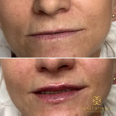 Hialuronika Kosmetologia Estetyczna - WŁOCŁAWEK